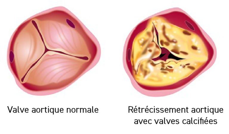 Valvuloplastie aortique ou dilatation aortique ICPS