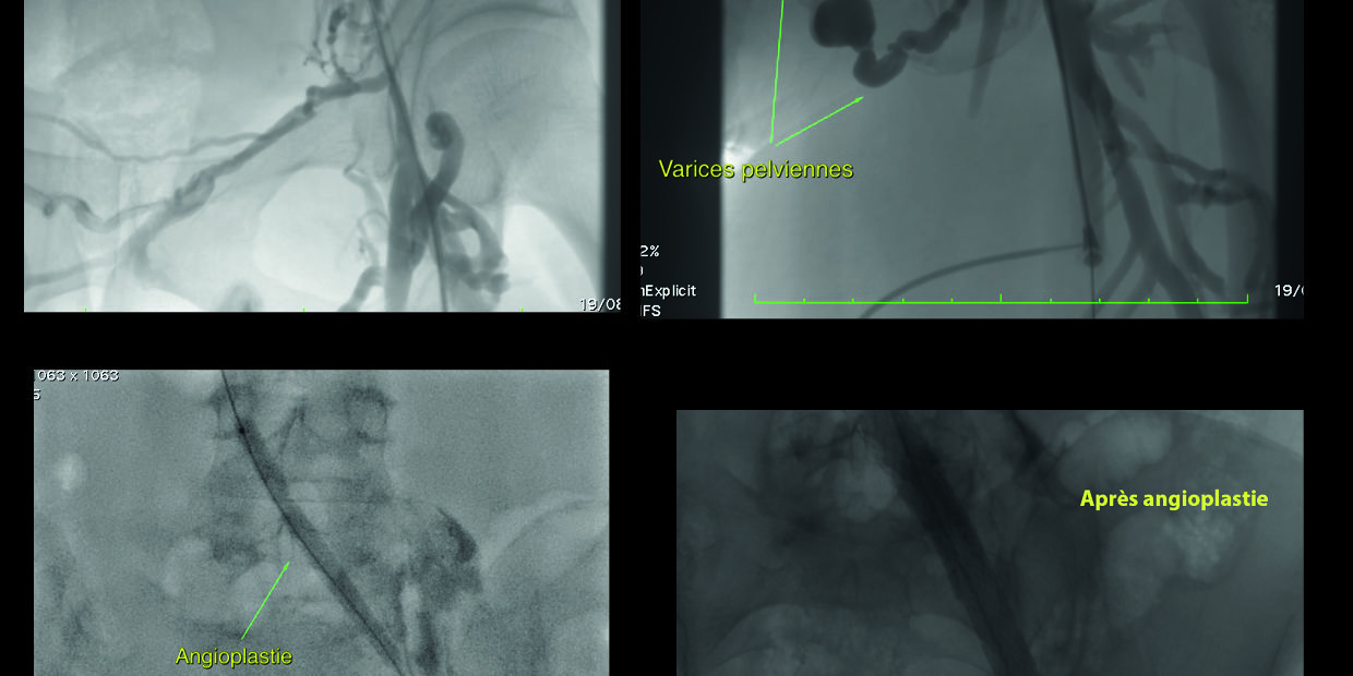 link Désobstruction veineuse