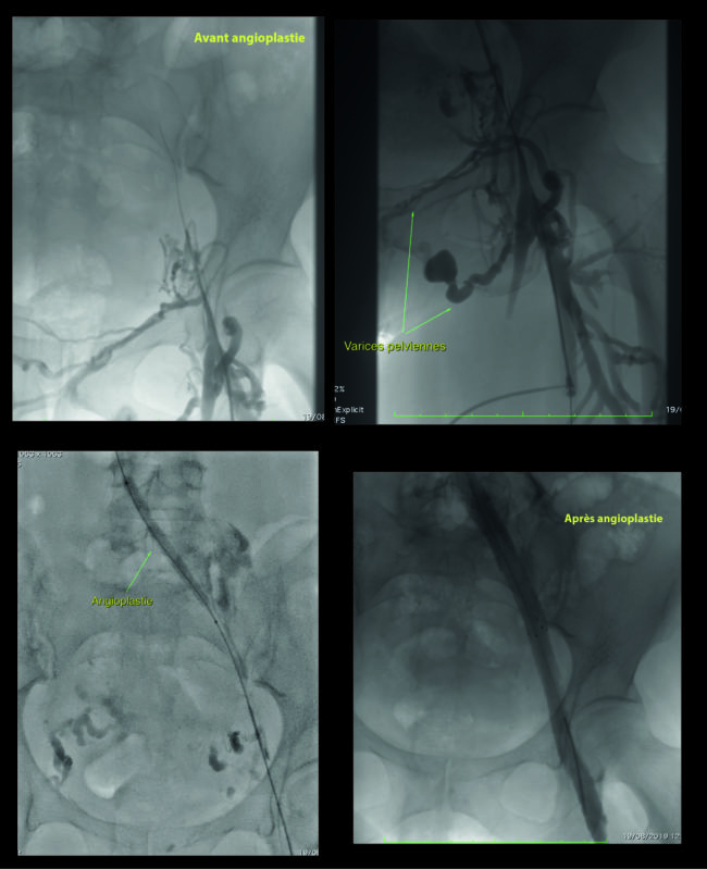 Désobstruction veineuse