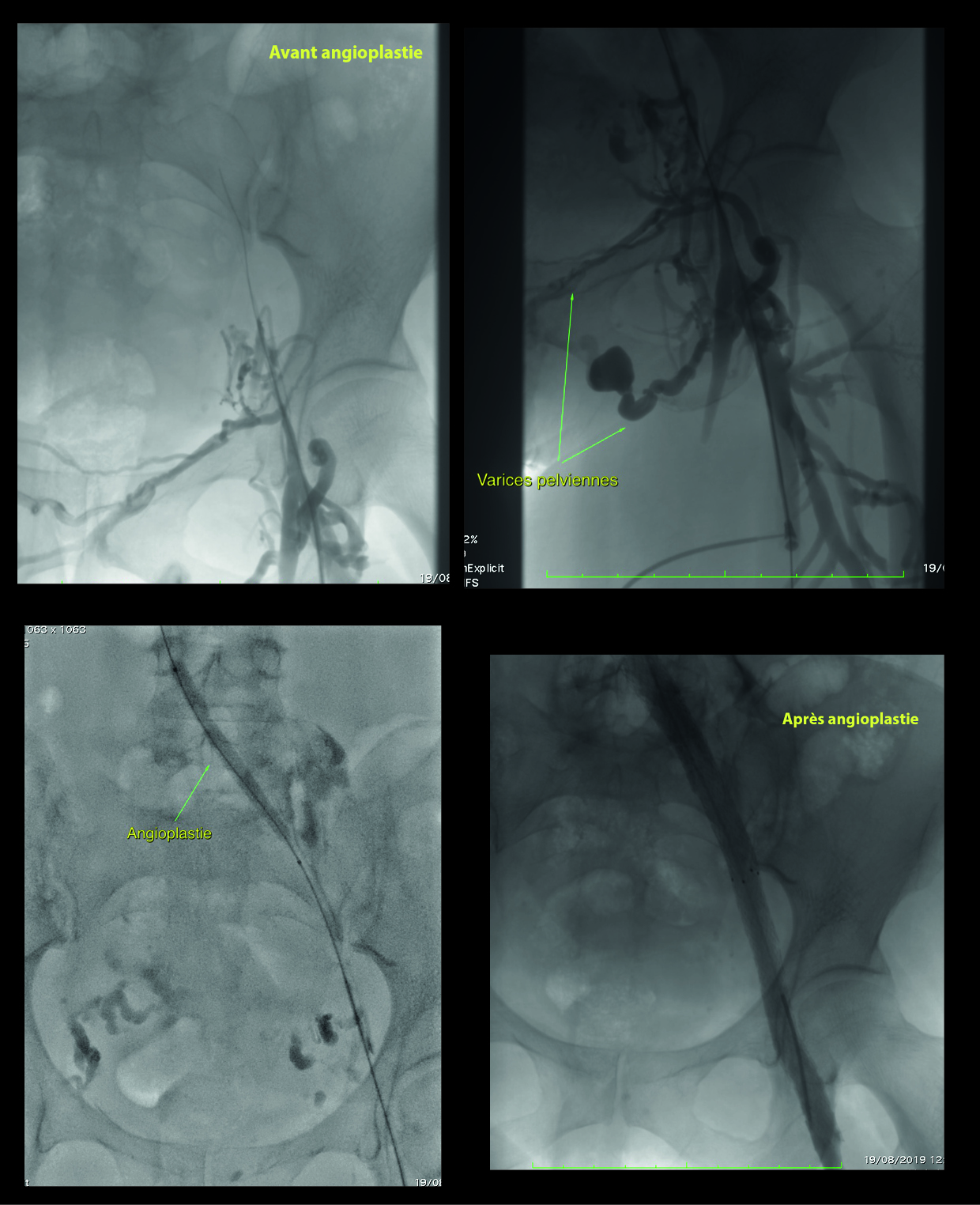 Désobstruction veineuse