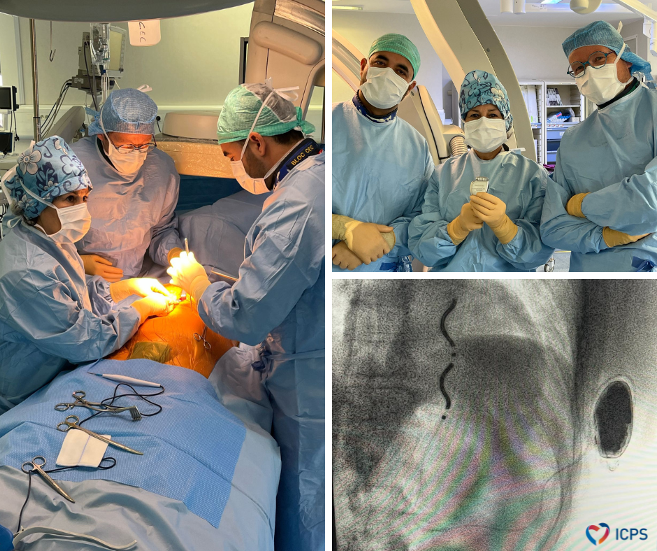 première procédure d'implantation de défibrillateur extra-vasculaire à l'ICPS